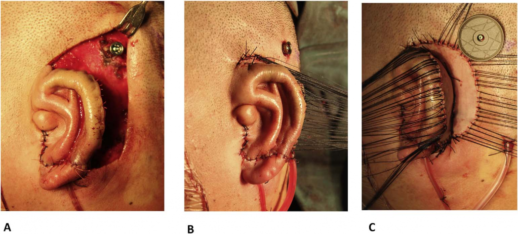 Измененная методика имплантации показывает совме-щение установки имплантата Ponto со вторым этапом рекон-струкции ушной раковины. 