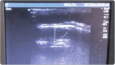 Изображение на мониторе УЗИ во время измерения толщины мягких тканей. Обратите внимание на то, что во время измерения зонд не должен сдавливать кожу. 